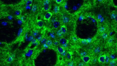 Complex Role of Immune Molecule in Huntington’s Disease