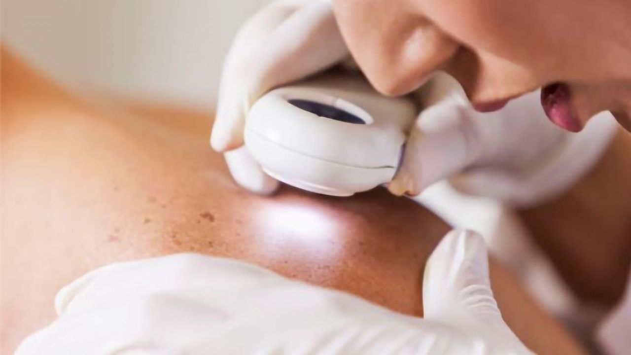 A New Method for Predicting the Evolution of Melanoma