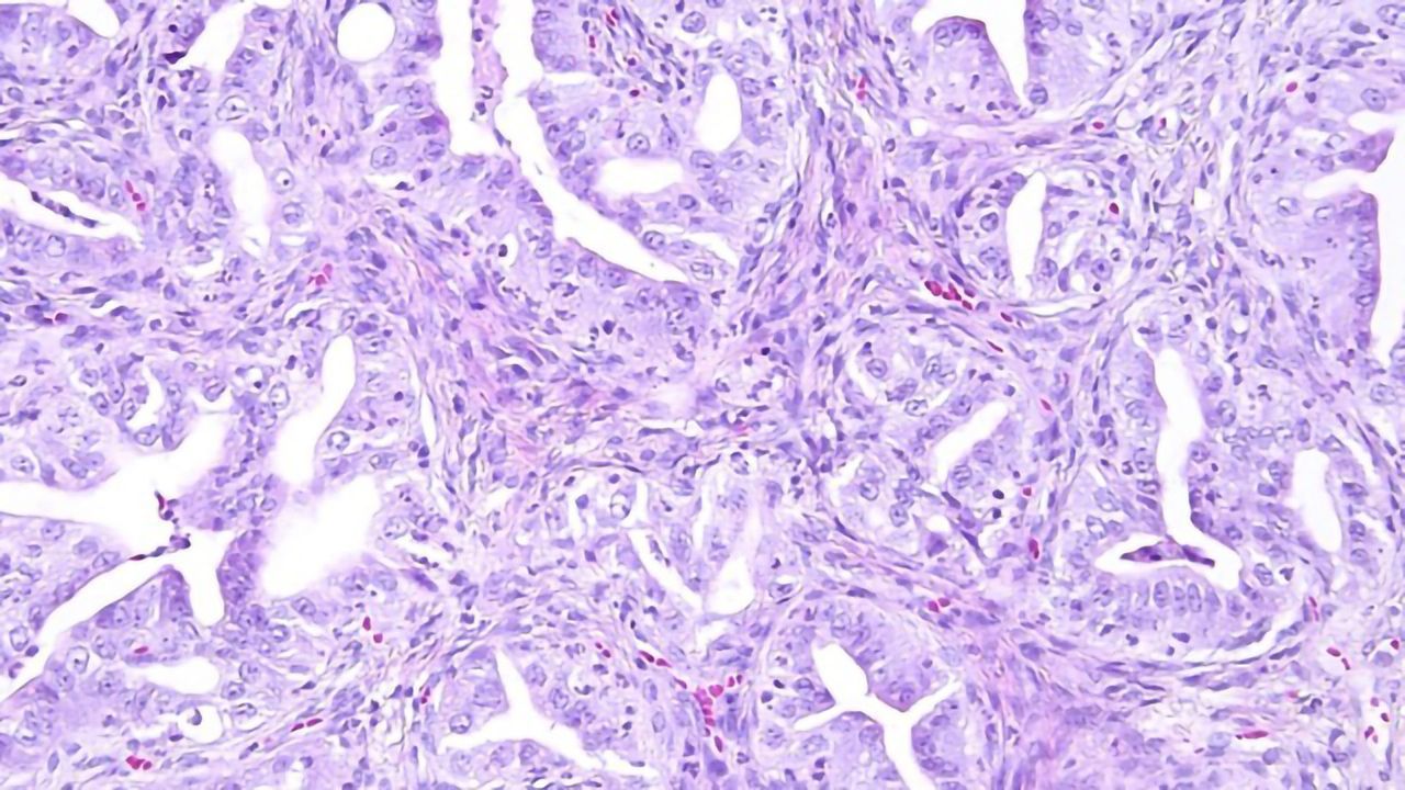 Modeling the Development of Ovarian Cancer With Organoids