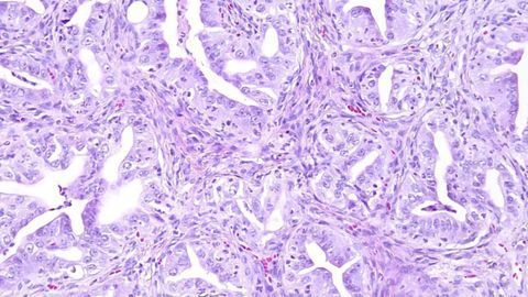 Modeling the Development of Ovarian Cancer With Organoids