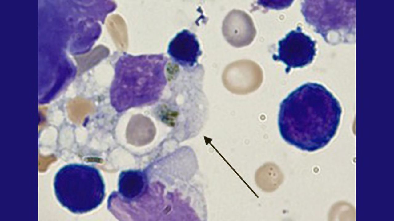 Immune Disease Model Points to Treatment for COVID-19 Cytokine Storms
