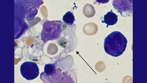 Immune Disease Model Points to Treatment for COVID-19 Cytokine Storms