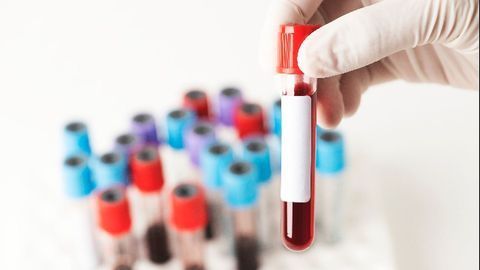 Markers in Blood Can Help Identify Risk for Complications After Mild TBI