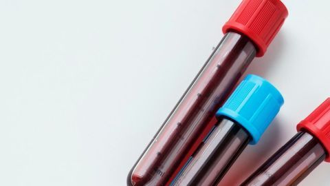 Analyzing Blood Metabolites in ALS Could Reveal or Rule Out Biomarkers for Disease