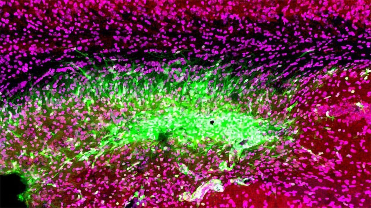 Immune Attack After Stroke