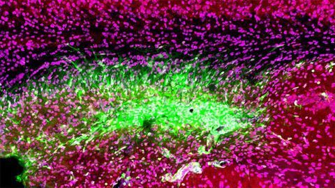 Immune Attack After Stroke