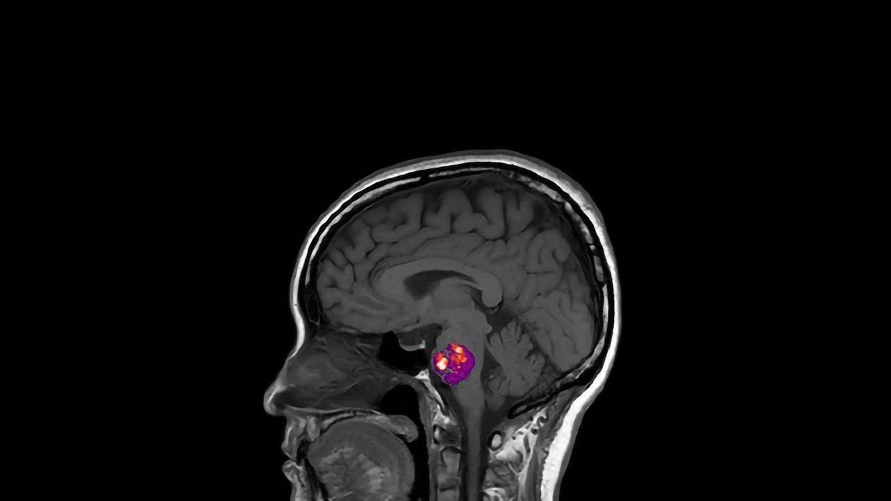 Stroke-causing Brittle Blood Vessels Linked to Gut Bacteria Signatures