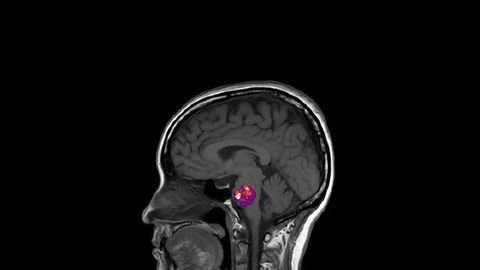 Stroke-causing Brittle Blood Vessels Linked to Gut Bacteria Signatures