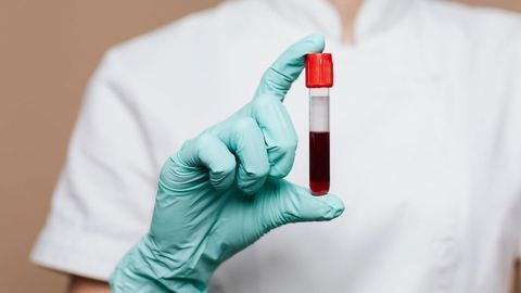 Differences Identified Between Blood Samples of Patients With Mild Versus Severe COVID-19 Clinical Signs
