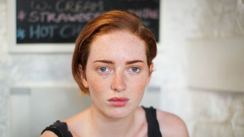 3D Facial Scans To Speed Diagnoses for Rare Genetic Diseases