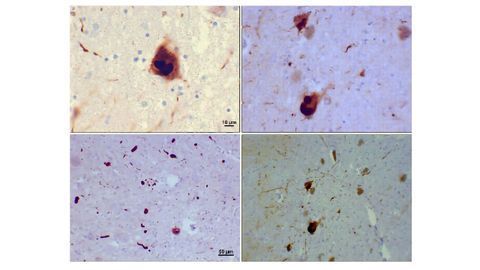 Why Do Proteins Misfold? The Answer Could Point to Parkinson's Disease Therapies