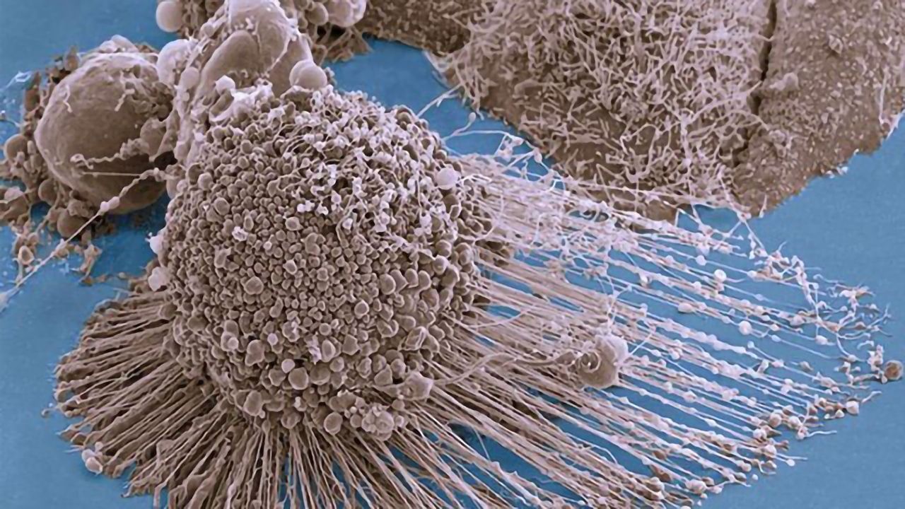 When Cancer Cells Can’t Produce Their Own Fat, They Import More of It