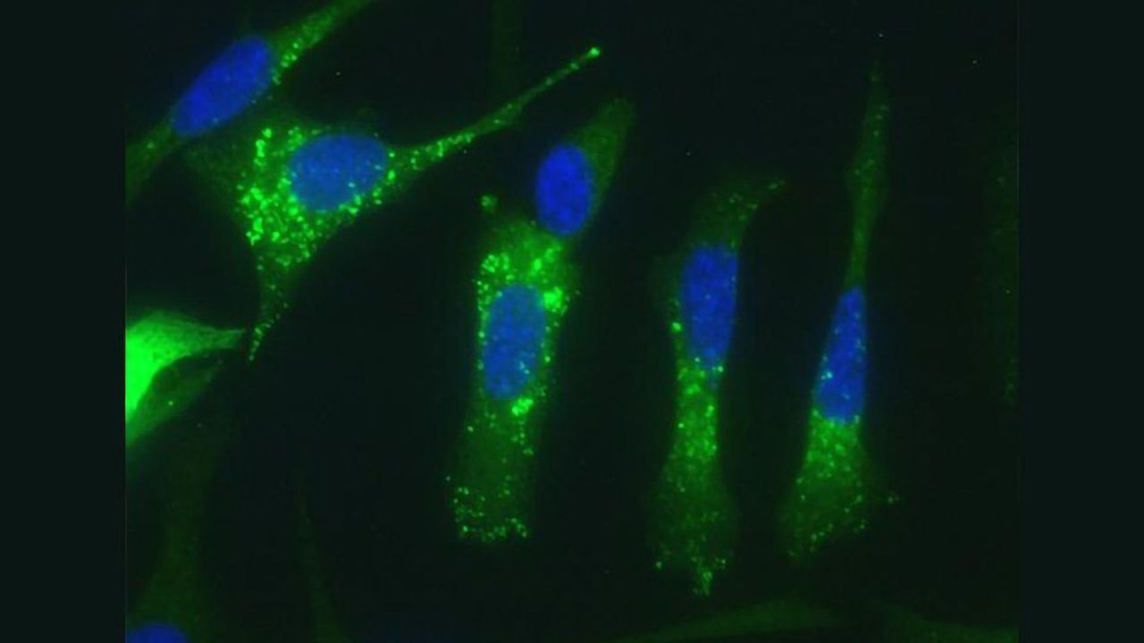 New Strategy Induces Stress Inside Tumors Causing Cancer Cell Destruction