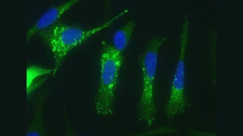 New Strategy Induces Stress Inside Tumors Causing Cancer Cell Destruction