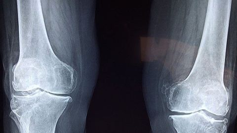 How Are Bone-dissolving Cells Generated?