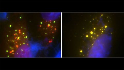 New Genetic Defect Linked to ALS