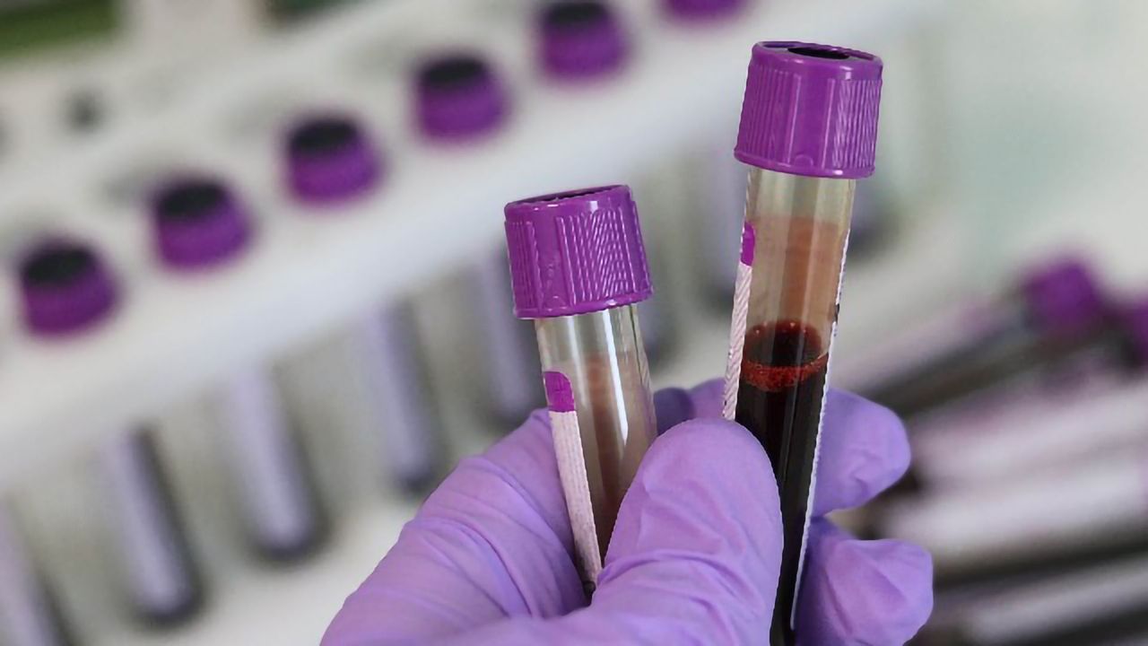 Blood Test May Help To Improve Liver Cancer Screening