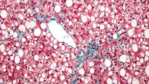 Novel Antisense Drug Could Help Slow Fatty Liver Disease