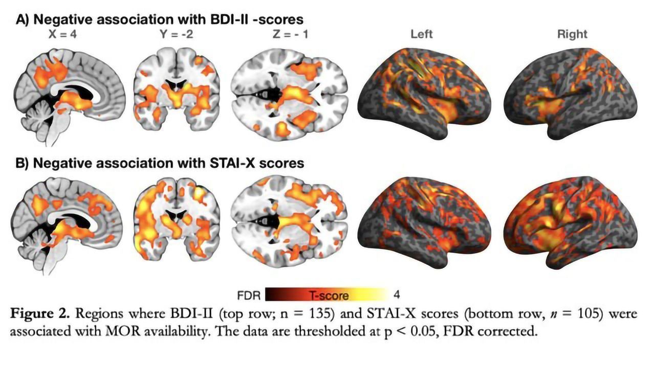 Brain's Opioid System Linked to Depression and Anxiety