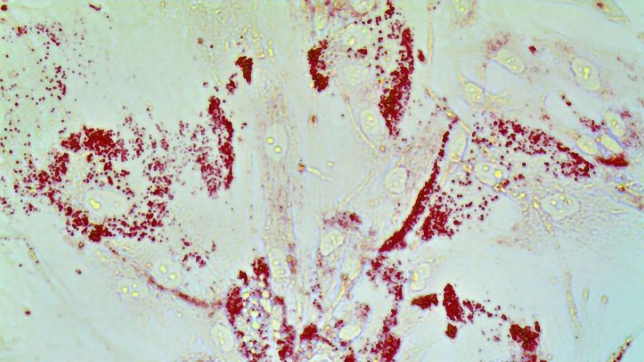 Loss of Lipid-regulating Gene Drives Spread of Prostate Cancer
