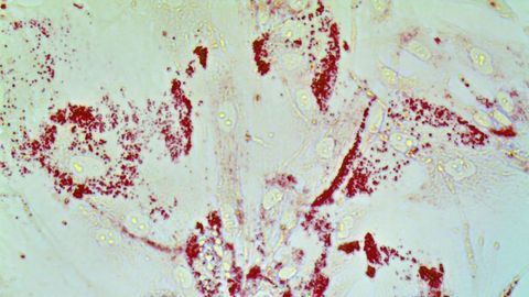 Loss of Lipid-regulating Gene Drives Spread of Prostate Cancer