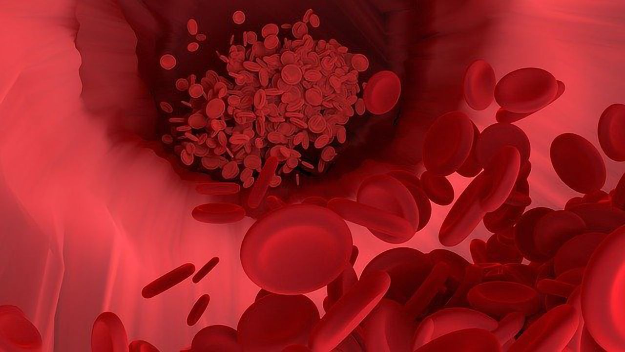 Novel Nanoparticle Drug Combo for Atherosclerosis