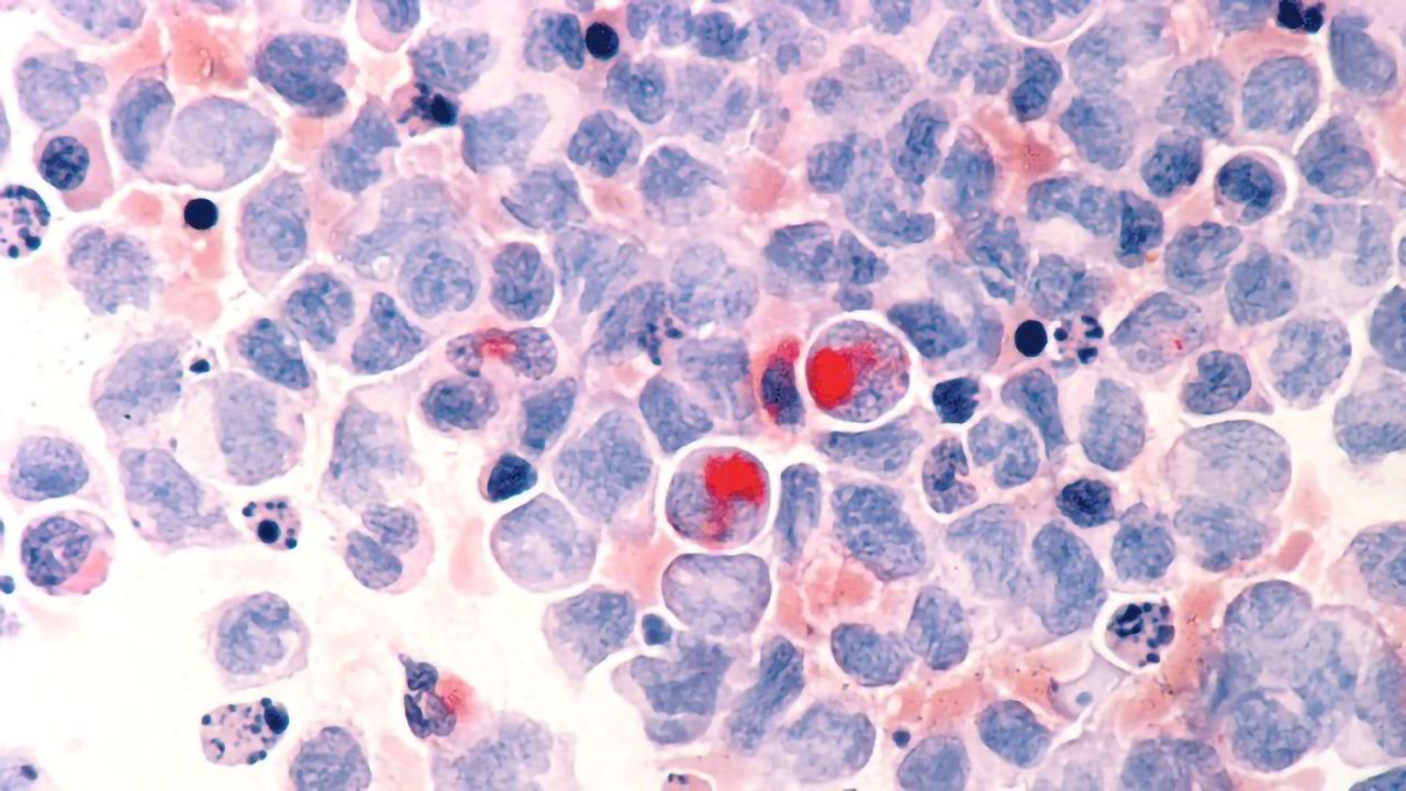 Nanoparticle Developed To Tackle Leukemia Treatment Resistance