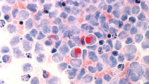 Nanoparticle Developed To Tackle Leukemia Treatment Resistance