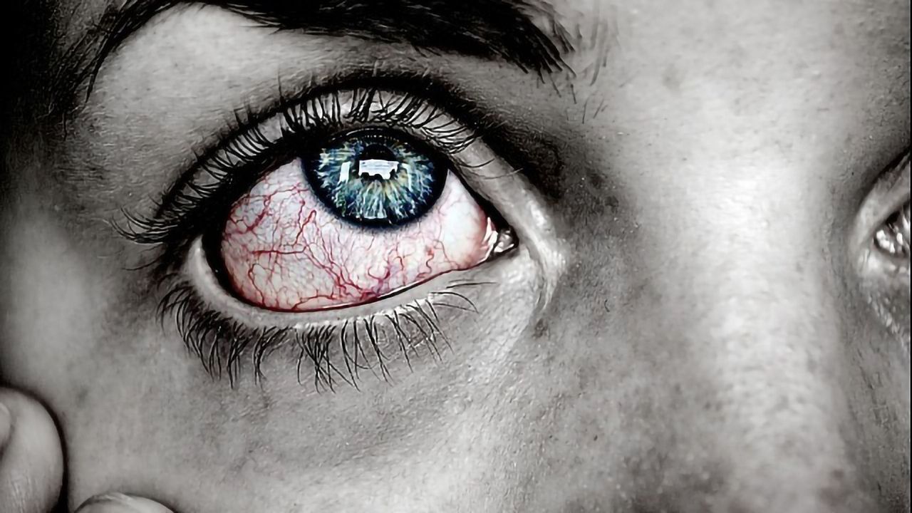 Clinician-Scientists Identify "Pink Eye" as Possible Primary Symptom of COVID-19