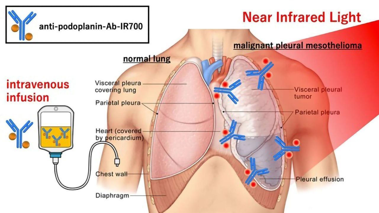 Using Near-infrared Light Therapy To Manage Malignant Lung Cancer