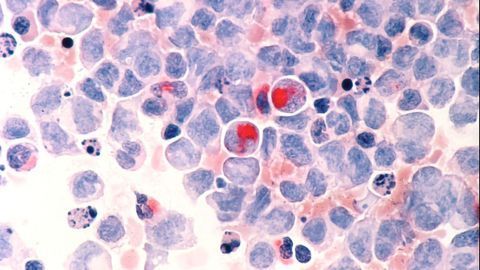 Targeting Stem Cells Could Help To Treat Poor-prognosis Leukaemia