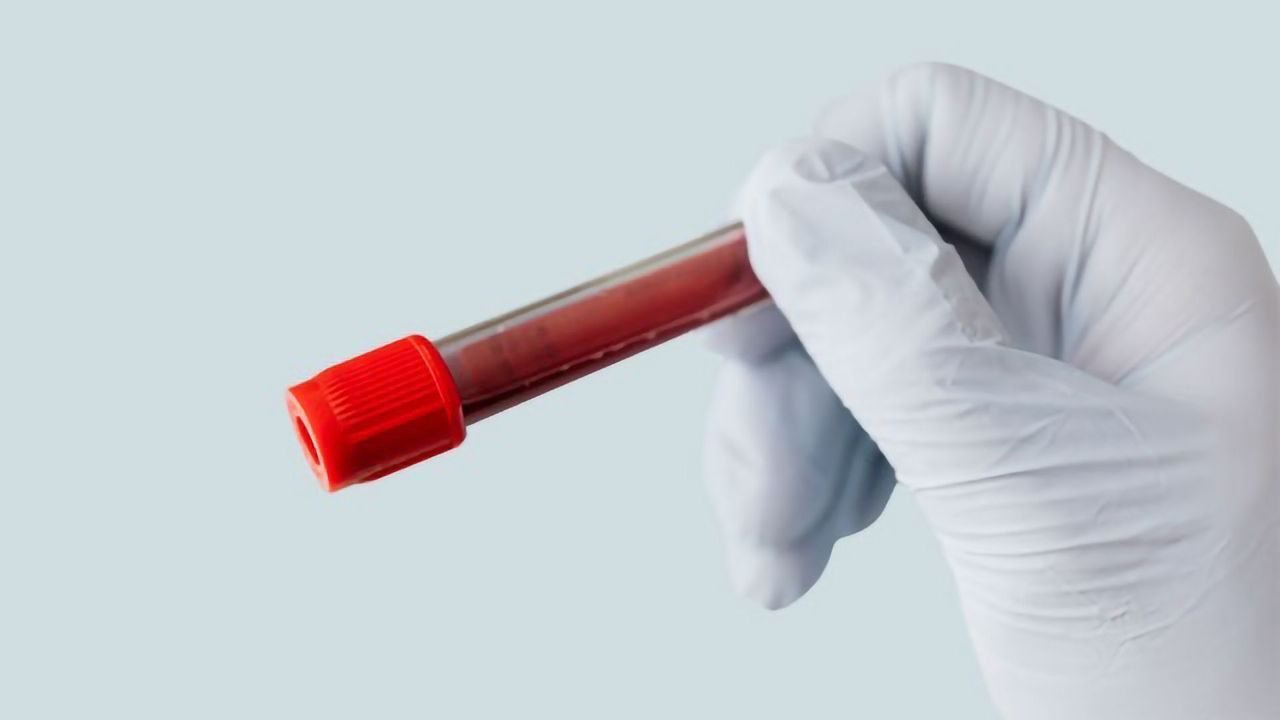 Biomarker Test Is Highly Accurate at Detecting Early Kidney Cancer