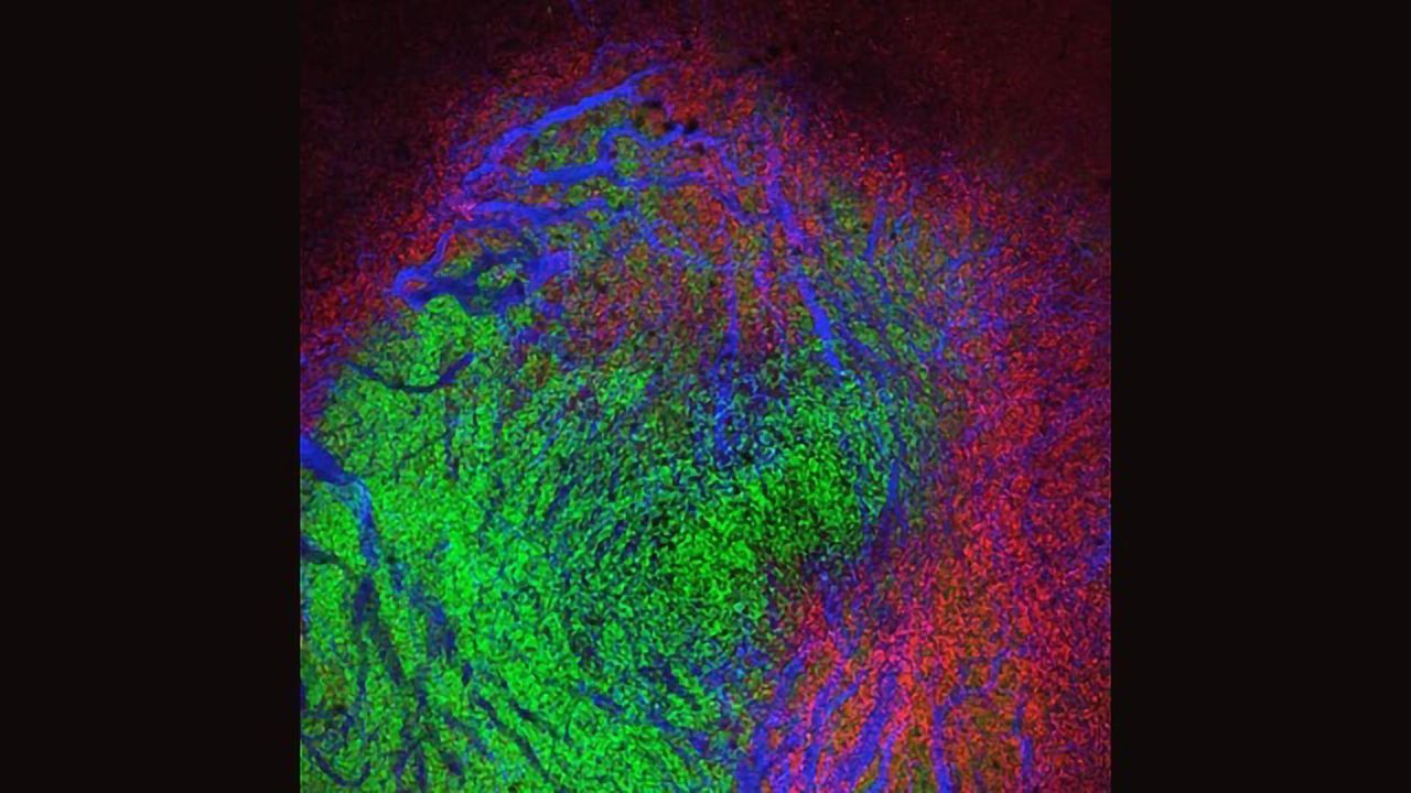 Tumor-infiltrating Immune Cells May Play Bigger Role in Cancer Than First Thought