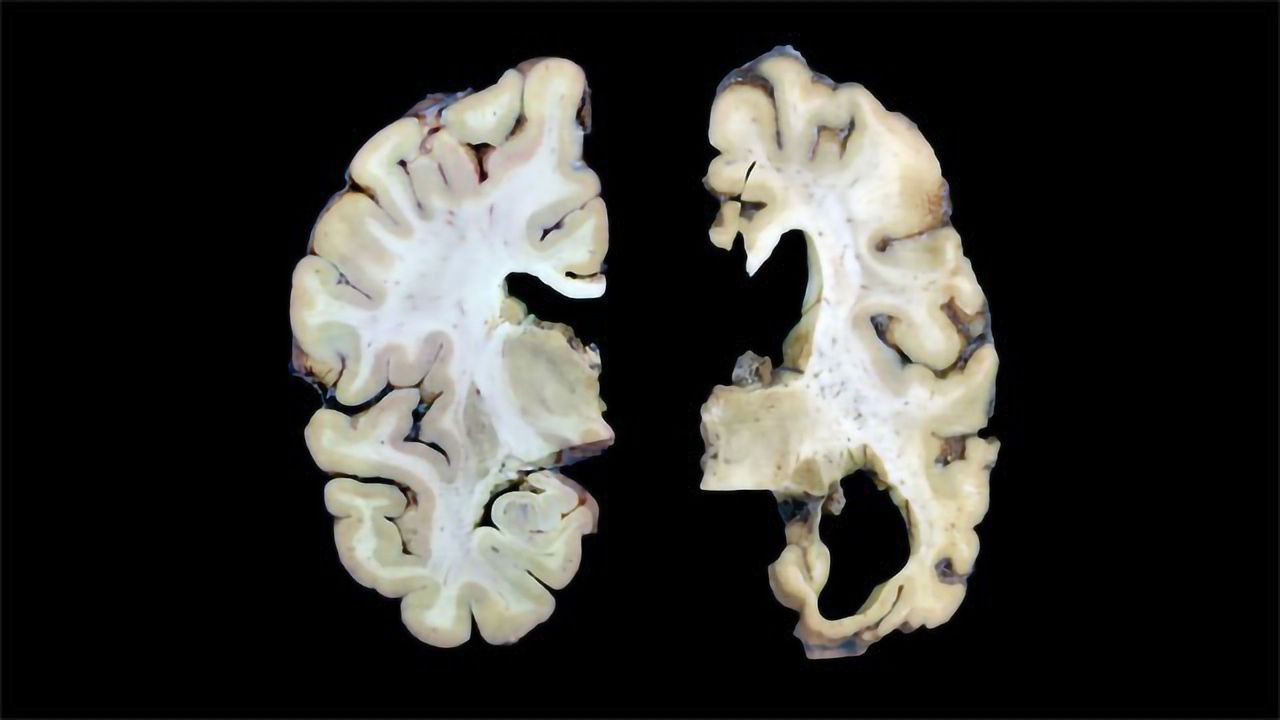 Normal Brain vs. Alzheimer’s Brain