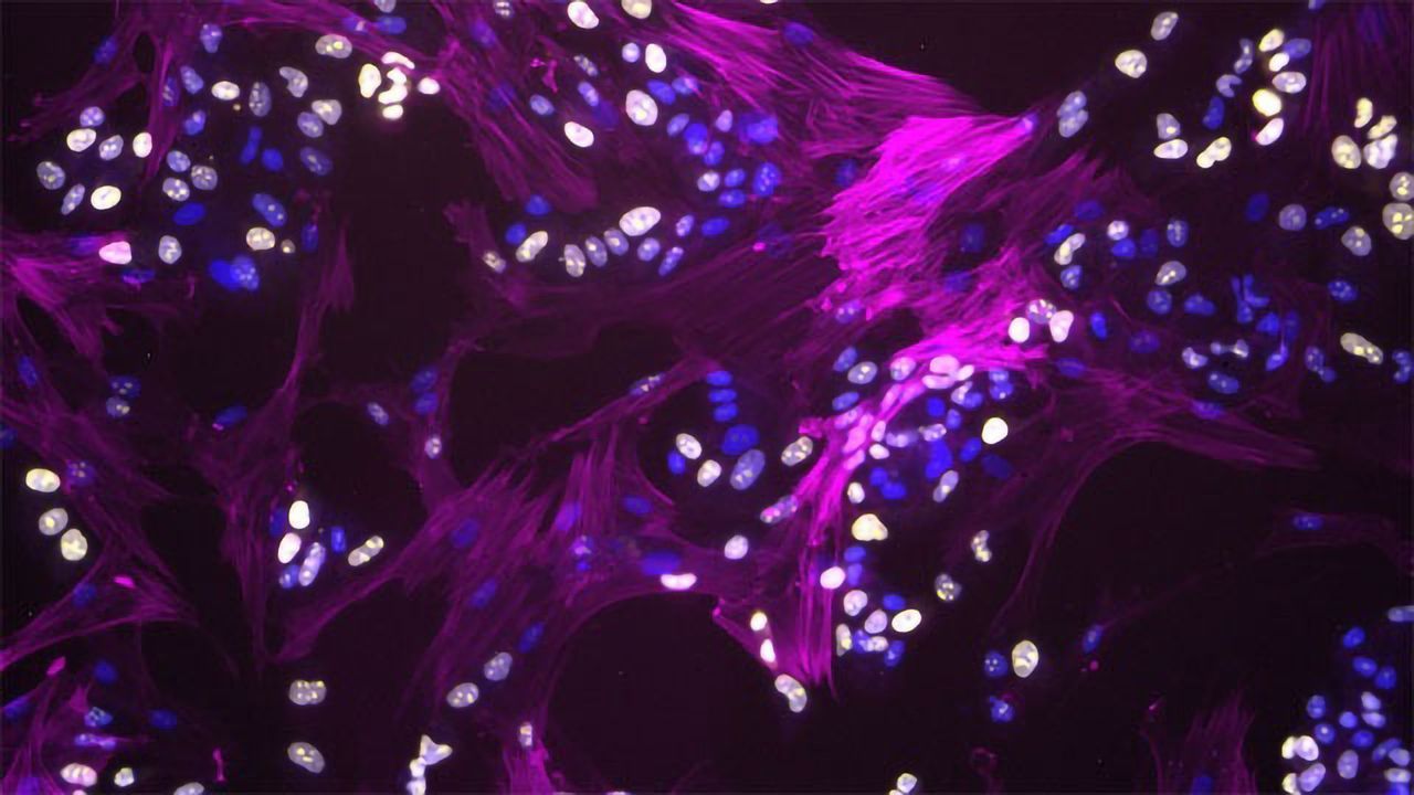 Fibroblasts Interacting with Breast Cancer Cells