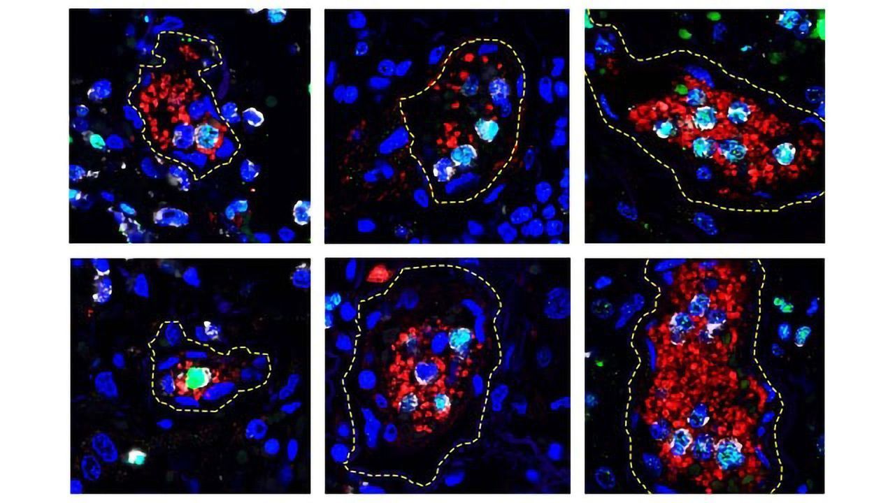 New Evidence for How Blood Clots May Form in Very Ill COVID-19 Patients