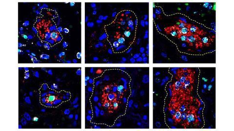 New Evidence for How Blood Clots May Form in Very Ill COVID-19 Patients