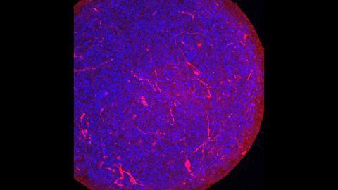 Findings From "Mini-brain" Study Suggest SARS-CoV-2 Can Infect Human Brain Cells