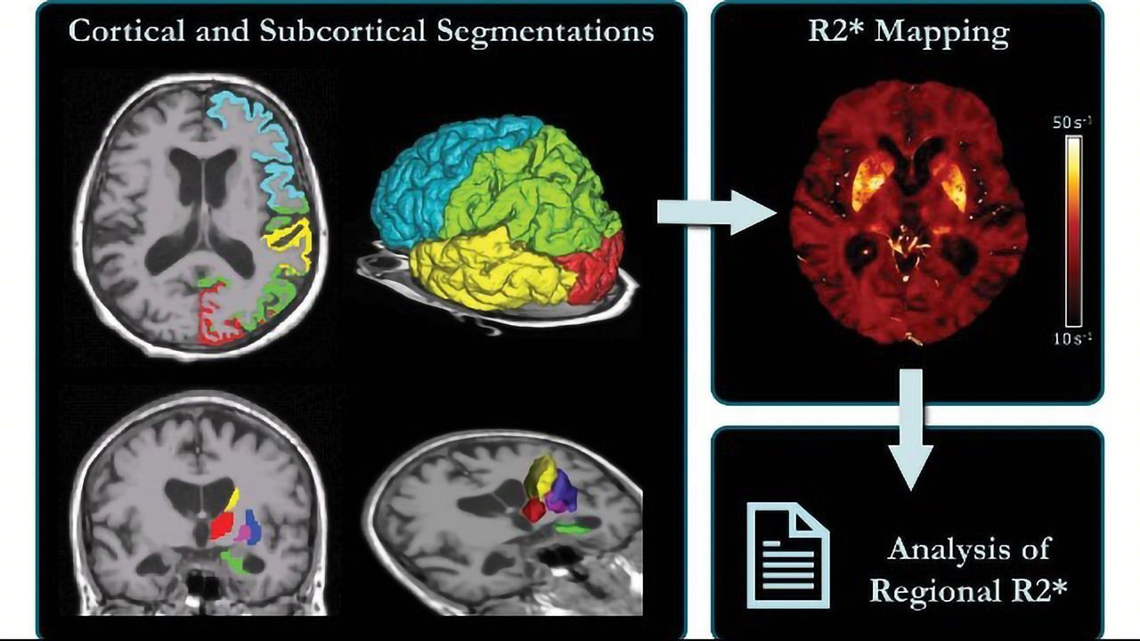Brain Iron Levels Linked to Cognitive Decline in Alzheimer’s