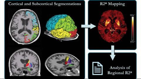 Brain Iron Levels Linked to Cognitive Decline in Alzheimer’s