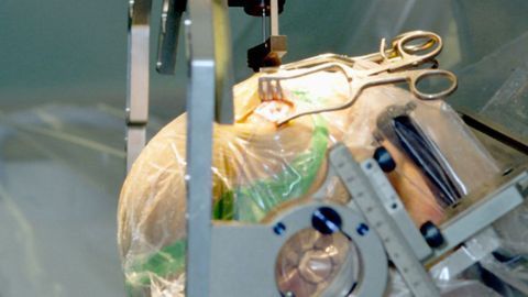 5-year Study Shows the Long-term Efficacy of Deep Brain Stimulation in Parkinson's