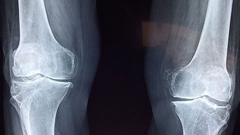 osteolabs Provides Further Validation for Use of OsteoTest