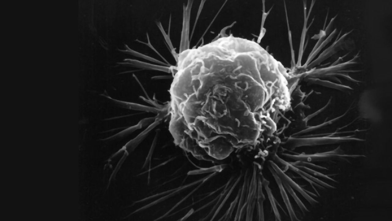 Chemo Drug May Be Less Effective in Overweight Women With Breast Cancer