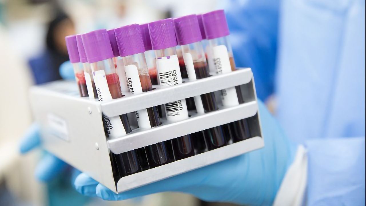 Blood Tests Can Help To Predict the Risk of Liver Cirrhosis