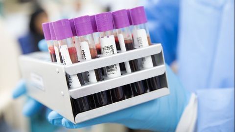 Blood Tests Can Help To Predict the Risk of Liver Cirrhosis