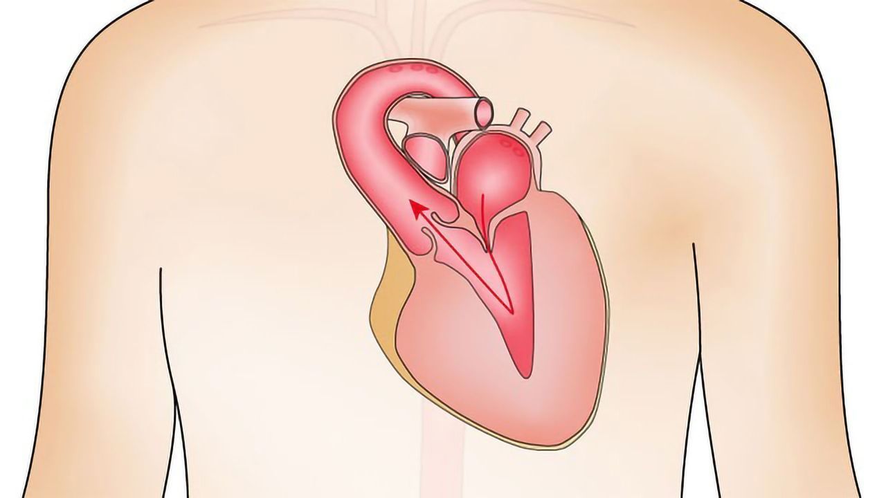 Heart Valve Disease Accelerated by Hyperactive Immune Cells