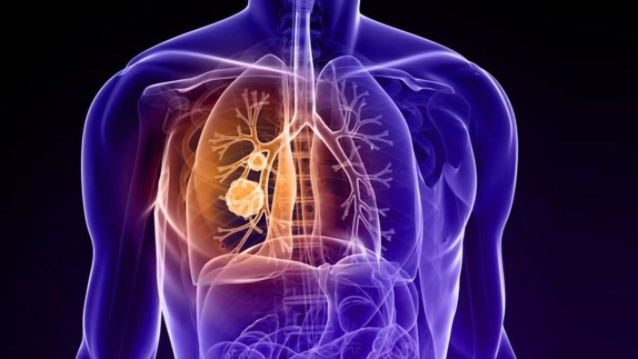 Lung Cancer in Non-smokers May Respond Differently to Treatment