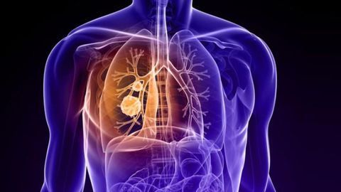 Lung Cancer in Non-smokers May Respond Differently to Treatment