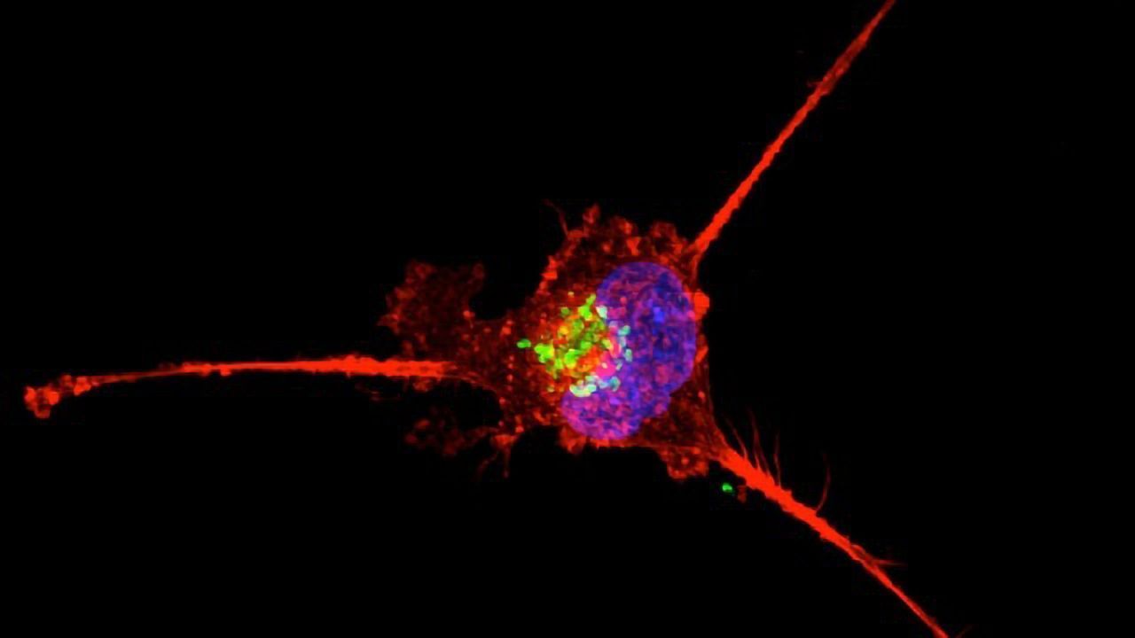 Blood-based Biomarkers Can Help To Predict Recurrence of Triple Negative Breast Cancer