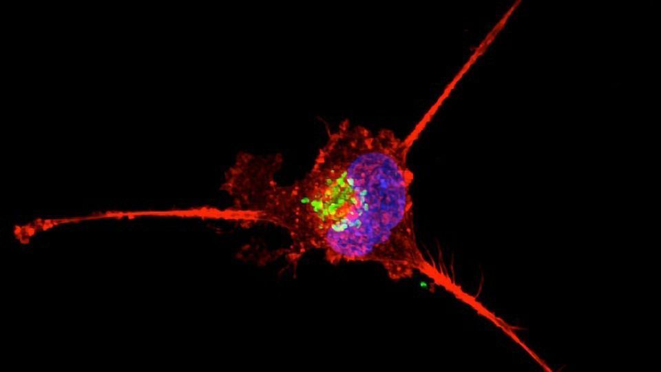 Blood-based Biomarkers Can Help To Predict Recurrence of Triple Negative Breast Cancer content piece image